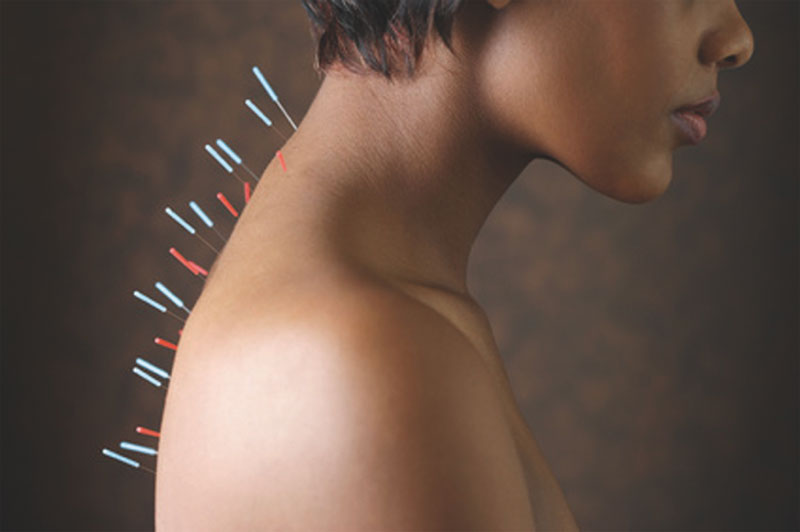 Akupunkturtag Rücken
